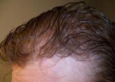 Prótese masculina (cabelo humano)