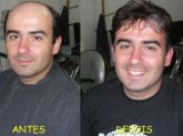 Prótese masculina (cabelo humano)