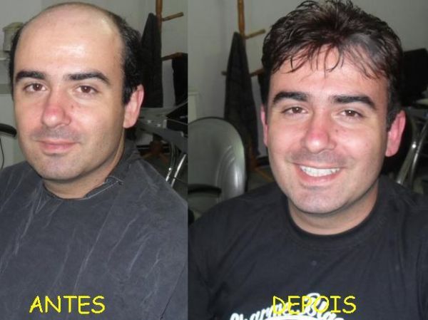 Prótese masculina (cabelo humano)